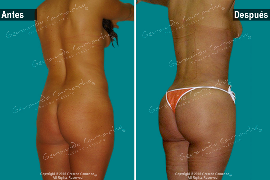 Procedimiento avanzado de gluteoplastia en Bogotá